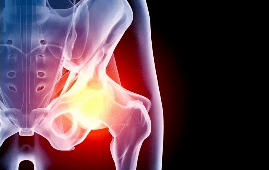 Hip joint arthropathy