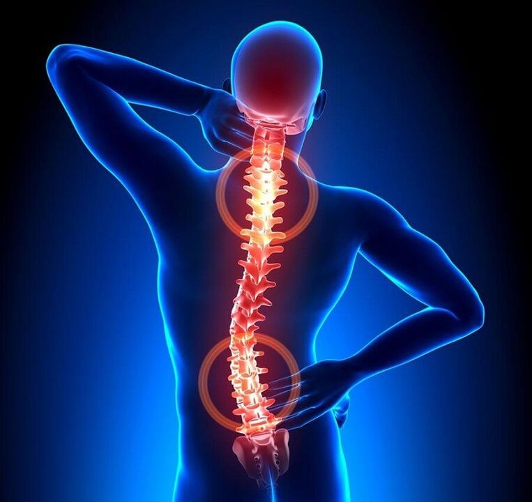 Spinal osteochondrosis is the cause of back pain