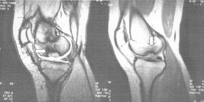 X-ray of osteochondrosis dissecans of the knee