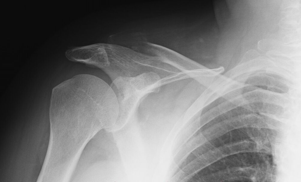 shoulder x-ray