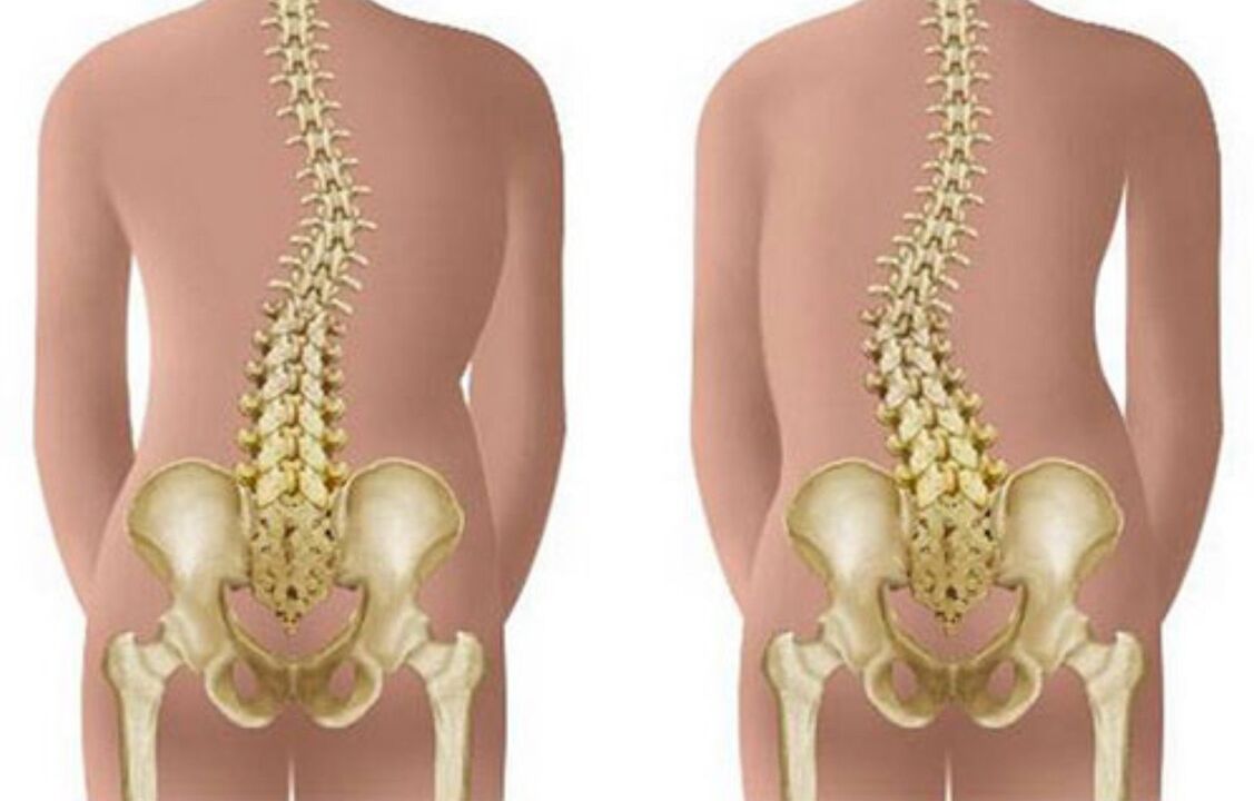 Scoliosis is the cause of back pain in the scapula area