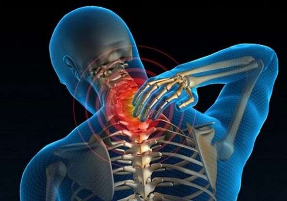 Neck pain due to osteochondrosis