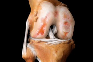 Knee injuries caused by joints