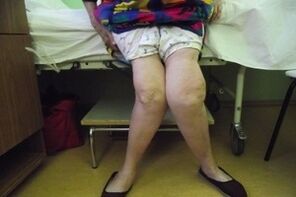 advanced knee arthritis